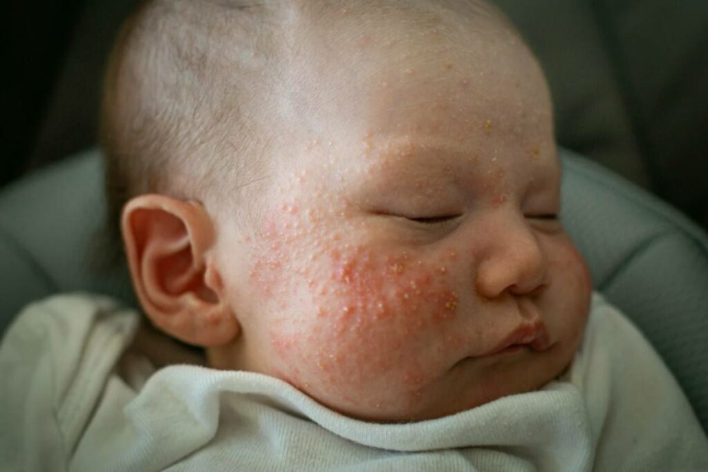 Brufoli sul viso del bambino: quando preoccuparsi e come intervenire correttamente