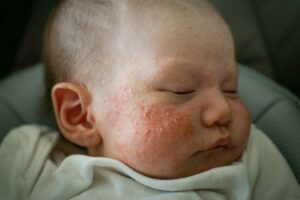 Brufoli sul viso del bambino: quando preoccuparsi e come intervenire correttamente